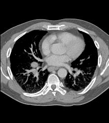 Pulmonary Edema and Failure- and Nodes - CTisus CT Scan