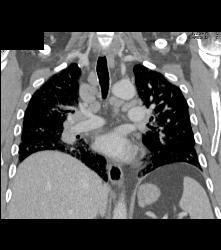 Pulmonary Edema and Failure- and Nodes - CTisus CT Scan