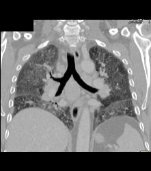 Pulmonary Edema and Failure- and Nodes - CTisus CT Scan