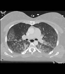 Pulmonary Edema and Failure- and Nodes - CTisus CT Scan