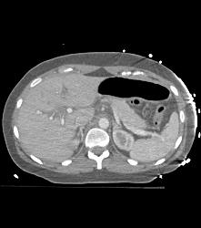 Pulmonary Hemorrhage - CTisus CT Scan