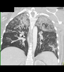 Pulmonary Hemorrhage - CTisus CT Scan