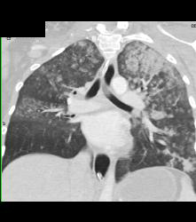 Pulmonary Hemorrhage - CTisus CT Scan