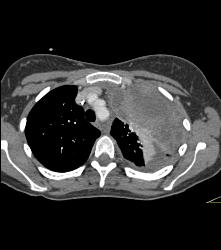 Ewing Sarcoma in Left Chest - CTisus CT Scan