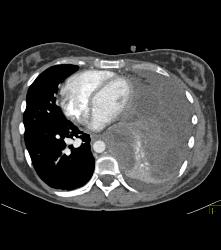 Ewing Sarcoma in Left Chest - CTisus CT Scan