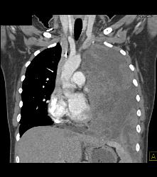 Ewing Sarcoma in Left Chest - CTisus CT Scan