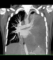 Ewing Sarcoma in Left Chest - CTisus CT Scan