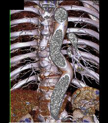 Nice Intercostals Off the Aorta - CTisus CT Scan