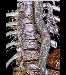 Nice Intercostals Off the Aorta - CTisus CT Scan