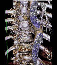 Nice Intercostals Off the Aorta - CTisus CT Scan