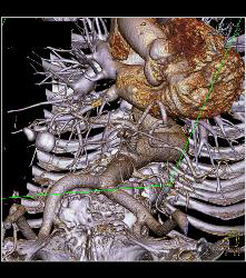 Nice Intercostals Off the Aorta - CTisus CT Scan