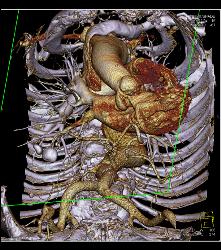 Nice Intercostals Off the Aorta - CTisus CT Scan