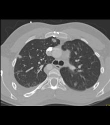 Septic Emboli - CTisus CT Scan