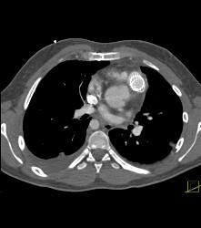 Repaired Coarctation of the Aorta - CTisus CT Scan