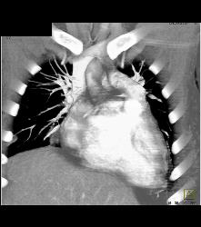 Repaired Coarctation of the Aorta - CTisus CT Scan