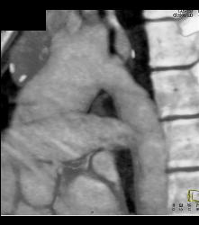 Repaired Coarctation of the Aorta - CTisus CT Scan