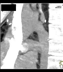 Repaired Coarctation of the Aorta - CTisus CT Scan