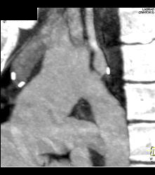 Repaired Coarctation of the Aorta - CTisus CT Scan