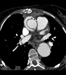 Repaired Ascending Aorta With Reimplanted Coronary Artery. Note Dissection Still in Descending Thoracic Aorta - CTisus CT Scan