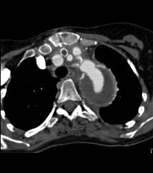 Repaired Ascending Aorta With Reimplanted Coronary Artery. Note Dissection Still in Descending Thoracic Aorta - CTisus CT Scan