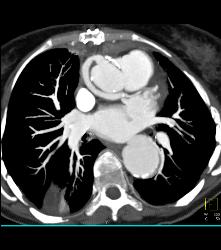 Repaired Ascending Aorta With Reimplanted Coronary Artery. Note Dissection Still in Descending Thoracic Aorta - CTisus CT Scan