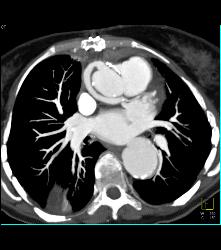 Repaired Ascending Aorta With Reimplanted Coronary Artery. Note Dissection Still in Descending Thoracic Aorta - CTisus CT Scan