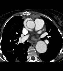 Repaired Ascending Aorta With Reimplanted Coronary Artery. Note Dissection Still in Descending Thoracic Aorta - CTisus CT Scan