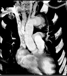 Repaired Ascending Aorta With Reimplanted Coronary Artery. Note Dissection Still in Descending Thoracic Aorta - CTisus CT Scan