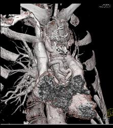 Repaired Ascending Aorta With Reimplanted Coronary Artery. Note Dissection Still in Descending Thoracic Aorta - CTisus CT Scan