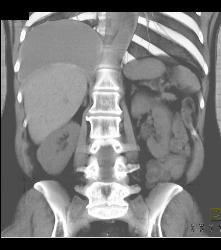 Ruptured Breast Implant Extends Into the Pleural Space - CTisus CT Scan