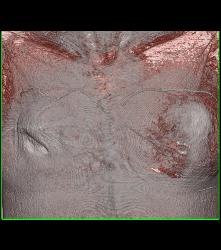 Ruptured Breast Implant Extends Into the Pleural Space - CTisus CT Scan