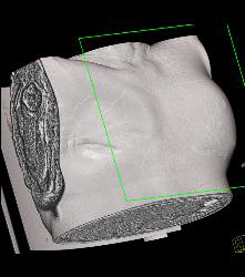 Ruptured Breast Implant Extends Into the Pleural Space - CTisus CT Scan