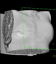 Ruptured Breast Implant Extends Into the Pleural Space - CTisus CT Scan