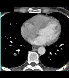 Pe - CTisus CT Scan