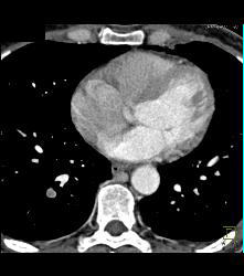 Pe - CTisus CT Scan