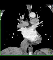 Pe - CTisus CT Scan