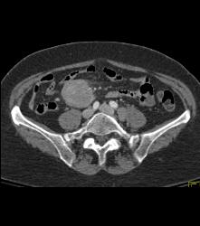 Lymphoma in Pleura and Ribs and Mesentery - CTisus CT Scan