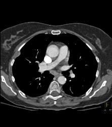 Lymphoma in Pleura and Ribs and Mesentery - CTisus CT Scan