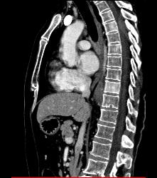 Lymphoma in Pleura and Ribs and Mesentery - CTisus CT Scan