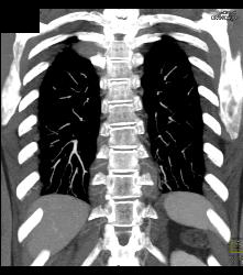 Lymphoma in Pleura and Ribs and Mesentery - CTisus CT Scan