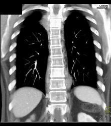 Lymphoma in Pleura and Ribs and Mesentery - CTisus CT Scan