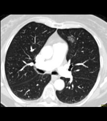 Ground Glass Nodule - Chest Case Studies - CTisus CT Scanning