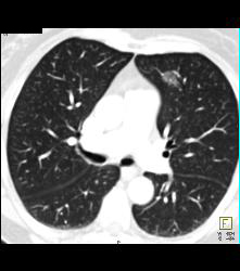 Ground Glass Nodule - CTisus CT Scan