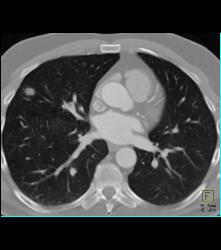 Sarcoidosis - CTisus CT Scan