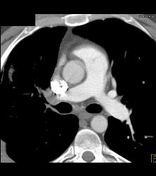 Sarcoidosis With Encased Right Pulmonary Vein - CTisus CT Scan