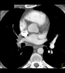 Sarcoidosis With Encased Right Pulmonary Vein - CTisus CT Scan