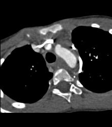 Mediastinal Hematoma - CTisus CT Scan