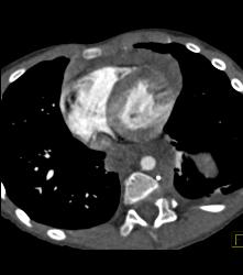 Mediastinal Hematoma - CTisus CT Scan