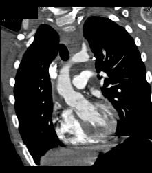 Mediastinal Hematoma - CTisus CT Scan