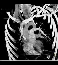 Mediastinal Hematoma - CTisus CT Scan